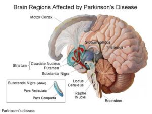 Parkinsons Disease and Other Movement Disorders 300x225 1